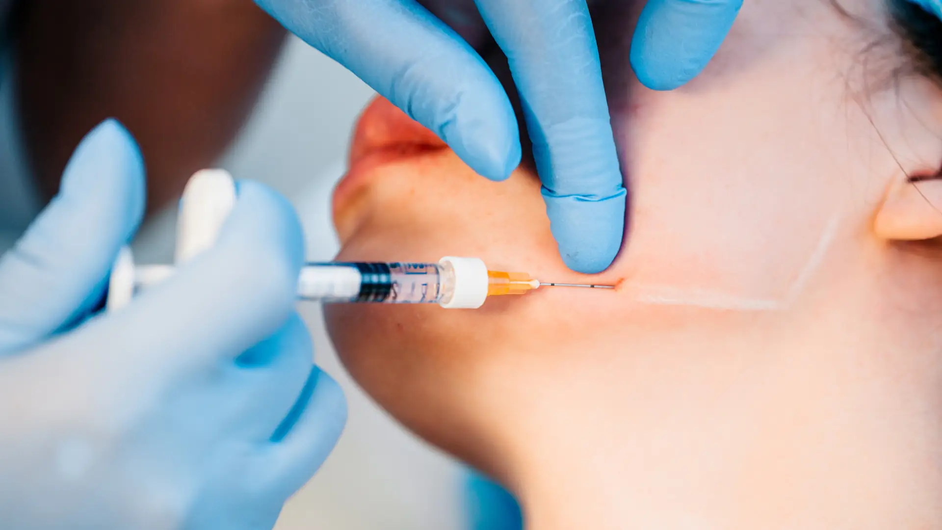 image showcasing jawline enhancement with dermal fillers at Haus of Giving Face in Clearwater, FL.